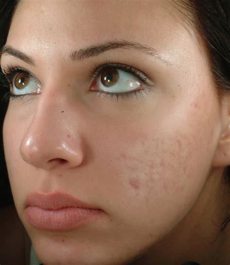 √ 2 Reasons Why You Get Acne Scars Goodbye Acne