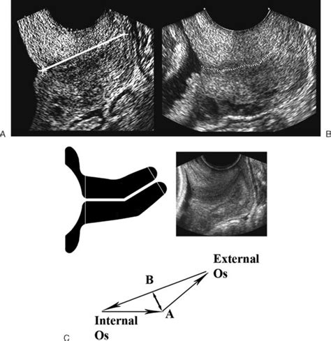 Ultrasound Evaluation Of The Cervix Radiology Key Obstetric