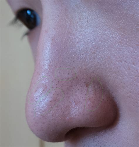 [with pictures] flesh colored bumps on nose hypertrophic raised scars