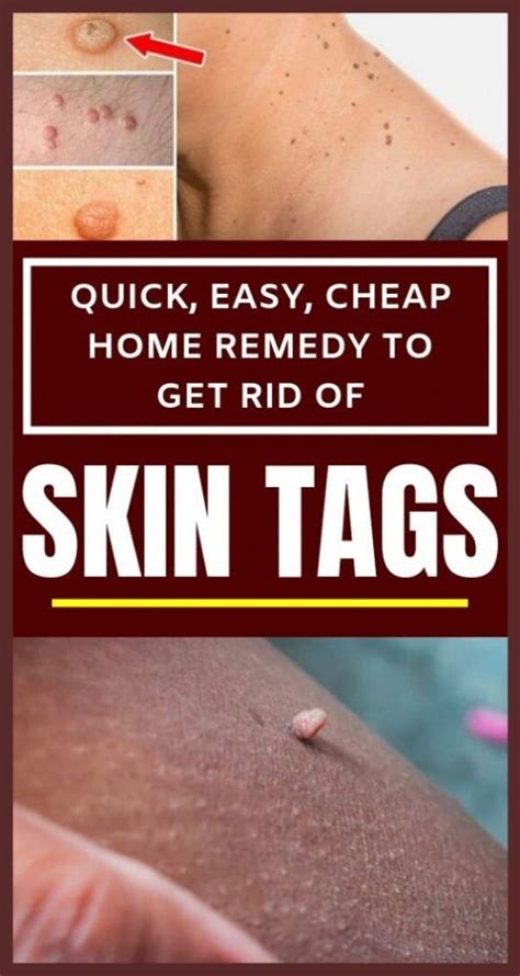 quick easy cheap home remedy to get rid of skin tags in 2020 skin tag home remedies remedies