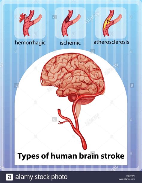 Types Of Human Brain Stroke Illustration Stock Vector Image And Art Alamy