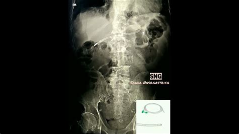 Raio X De Sonda Nasoenteral Ensino