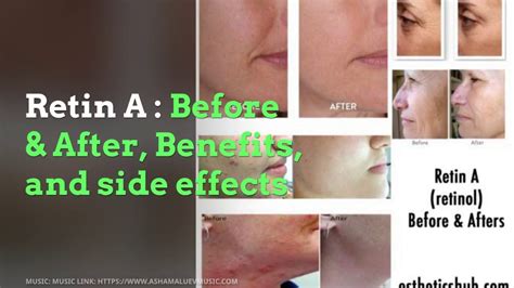 Retin A Before And After Benefits Anti Aging Skin Benefits Acne