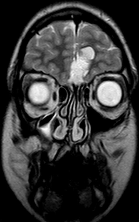 Nasofrontal Dermoid Sinus Bmj Case Reports