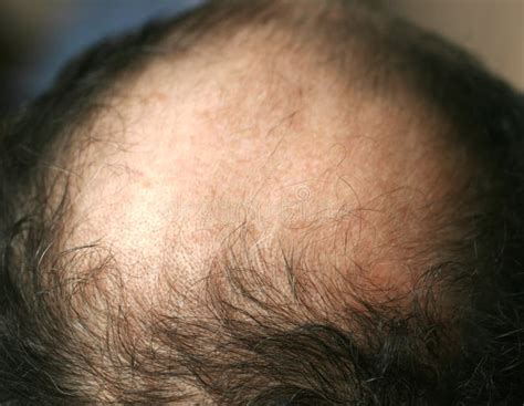 A Bald Spot On A Man`s Head Alopecia Hair Loss Stock Photo Image Of