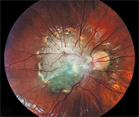 Combined Hamartoma Of The Retina And Retinal Pigment Epithelium Leading