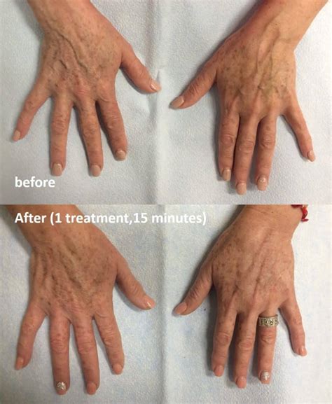 Handscaping™ Hand Vein Treatment East Bay Vein Specialists