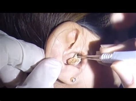 Disgusting Moment Huge Ear Wax Build Up Is Pulled From Woman S Ear YouTube