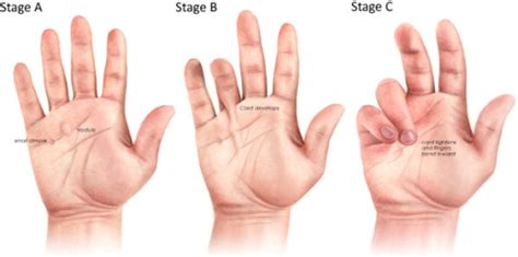 Different Stages Of Dupuytrens Disease Progression St Open I
