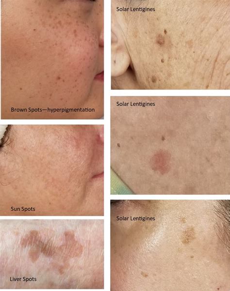 How To Get Rid Of Red Sun Spots On Face Learn Which Age Spot Skin