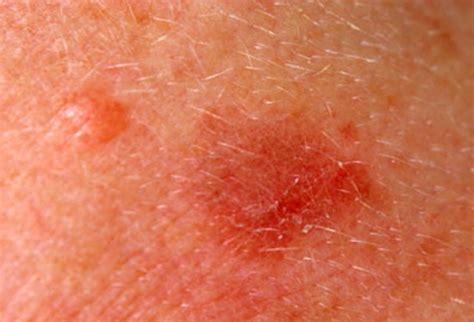 Actinic Keratosis Pictures Causes And Treatment