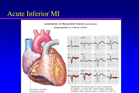 Ppt Acute Myocardial Infarction Powerpoint Presentation Free
