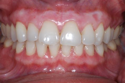 Gum Bleaching Is It For You Dental Implants Chrysalis Dental
