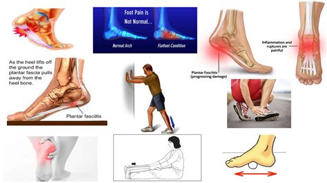 Correct Plantar Fasciitis Quickly Medically Proven The Best Exercises And Stretches Dr
