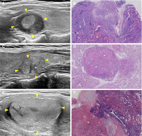 Three Cases Of Thyroid Nodules Occurred With Kras Nras And Tert