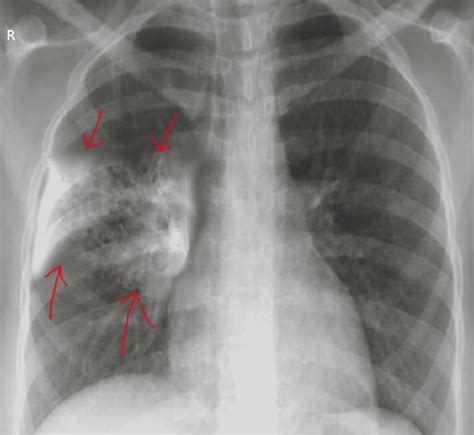 Figure Aspiration Pneumonia Chest Radiograph Demonstrating Alveolar