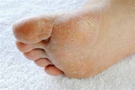 Causes For Itchy Hands And Feet Especially At Night Fashion And Beauty