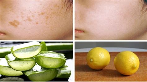 Dark Spots Can Be Eliminate With These 5 Organic Foods That You Have At