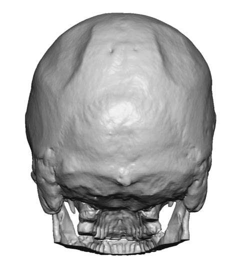 Parietal Skull Indentation 3d Ct Scan Back View Dr Barry Eppley
