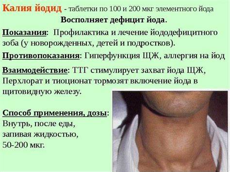 Меню безйодовая диета Зоб щитовидной железы: классификация, симптомы и лечение зоба щитовидки Зоб щитовидной железы: классификация, симптомы и лечение зоба щитовидки Меню безйодовая диета