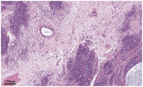 A Rare Case Of Sclerosing Stromal Tumor Of The Ovary Presenting In