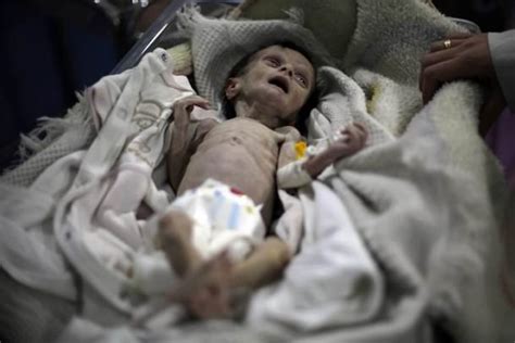 Imagens De Bebé Sírio Desnutrido Emocionam O Mundo Artigo Com Imagens