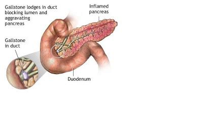 Cystic fibrosis (cf) is a disease of exocrine gland function that involves multiple organ systems but. Science & Medicine: Pancreatitis