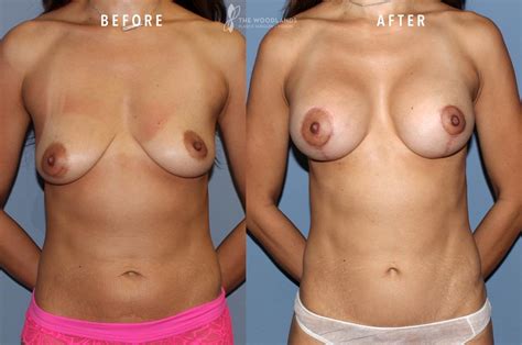 Mommy Makeover Before After Gallery The Woodlands Plastic Surgery