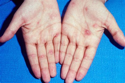 However infection in heterosexual males and females is becoming. Derm Dx: A single chancre progresses to a diffuse rash ...