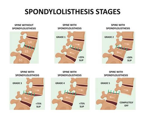 Spondylosis Thesis Spondylolisthesis Grade Adalah Pdf Libertyparkusafd