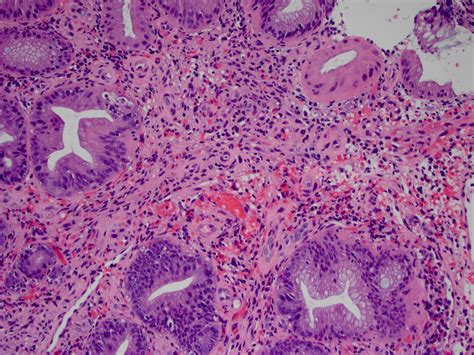 Authored by dr roger henderson, reviewed by. Pathology Outlines - Kaposi sarcoma