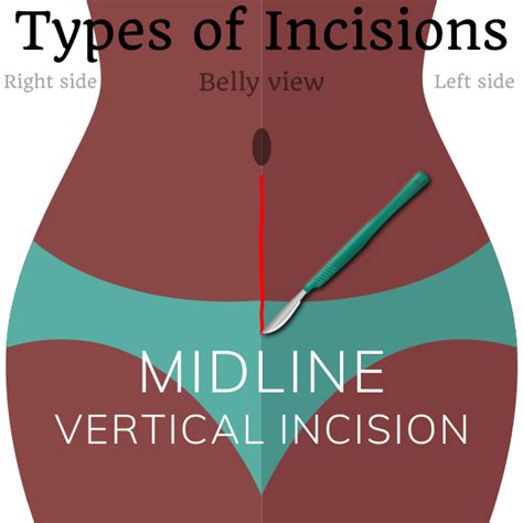 Surgical Incisions With Images Medical Mnemonics Medi