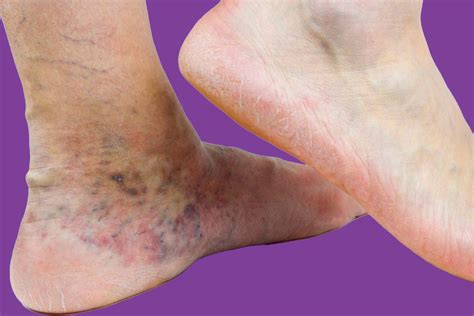 Venous Stasis Dermatitis Symptoms Causes Treatments And More Pure Medical