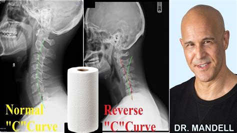 How A Paper Roll Can Restore Your Bad Neck Curve Dr Alan Mandell Dc