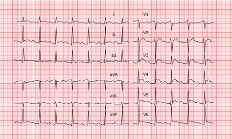 Pericarditis is inflammation of the pericardium (the fibrous sac surrounding the heart). Péricardite aiguë - ECG