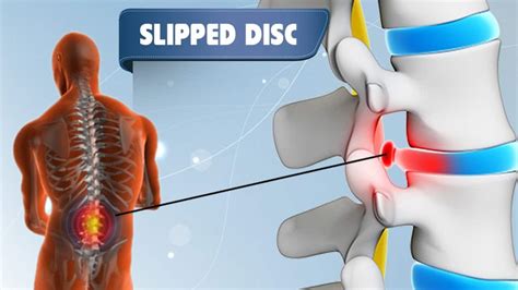 A slipped disc occurs when the gel covering a disc in the spine herniates and shifts, due to degeneration of disc elasticity. Herniated disc, Prolapsed disc, Slip disc Treatment in ...