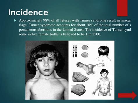 Turner Syndrome Online Presentation