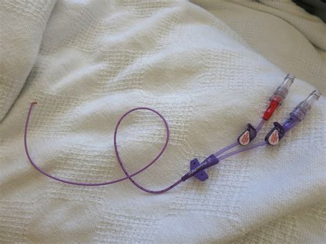 Jms Adventure With Multiple Myeloma 2nd Asct Day 26 Picc Line