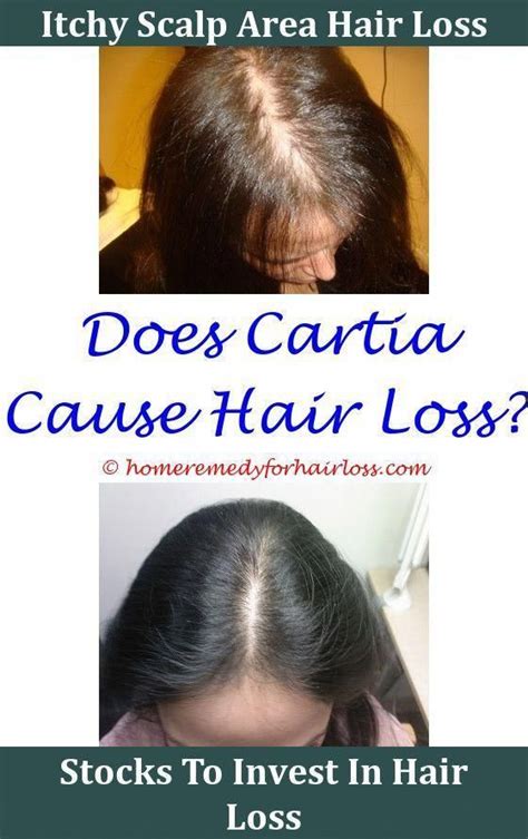 Abnormal hair loss is caused when hair falls out at an accelerated rate or, in case of overtime, the hair is not replaced as quickly as it falls out. Loss of hair may be abnormal if you are shedding even more ...