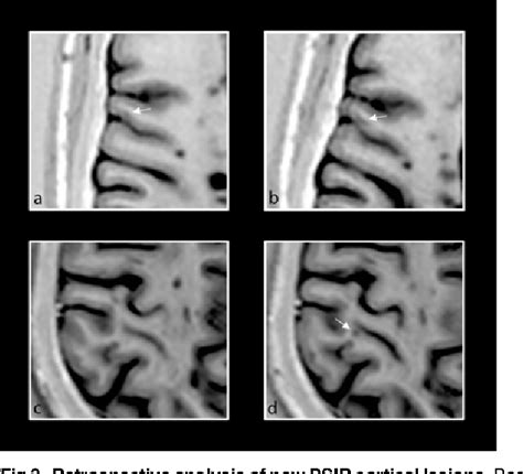 Figure From Phase Sensitive Inversion Recovery Mri Improves