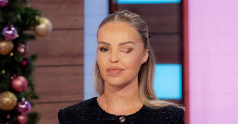 Katie Piper Making The Best Of Life After Painful Surgery To Avoid