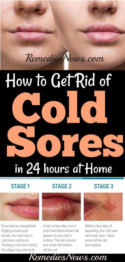 How To Heal Open Sores On Face Fast Heal Mania