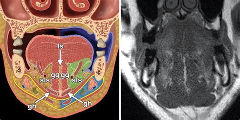 Primary Lesions Of The Root Of The Tongue Radiographics