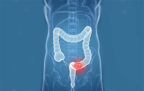 Colorectal Cancer 6 Things You Must Understand About It