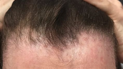 Details Hairstyles For Frontal Fibrosing Alopecia Vova Edu Vn