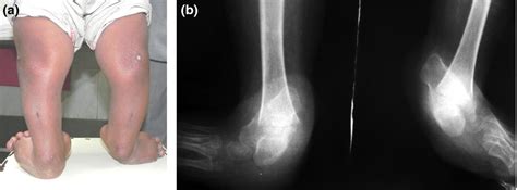 Skin Dimples Kumar 2014 International Journal Of Dermatology Wiley Online Library