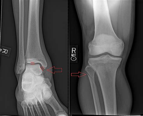 Maisonneuve Fractures Core Em