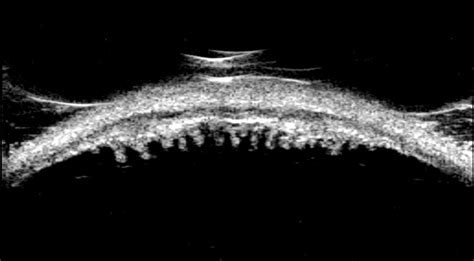 Ubm Of Ciliary Process Retina Image Bank