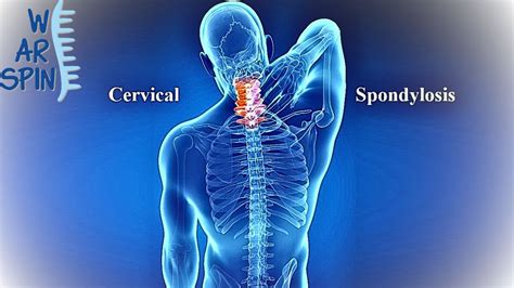 Cervical Spondylosis Symptoms Causes And Treatment
