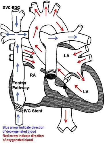 Covid 19 In An Adult With Tricuspid Atresia Sp Fontan Palliation